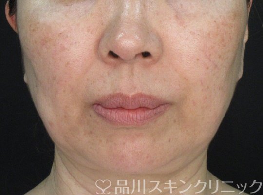 症例NO.70955のAFTER写真