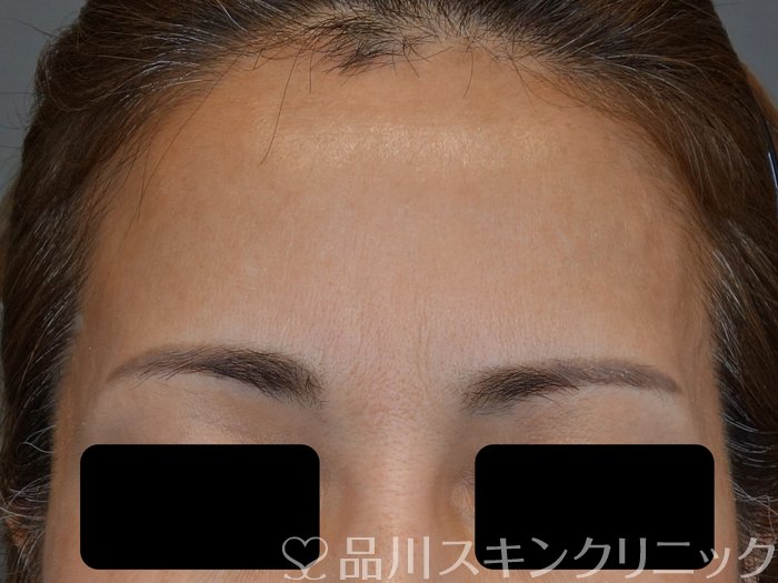 症例NO.73466のBEFORE写真