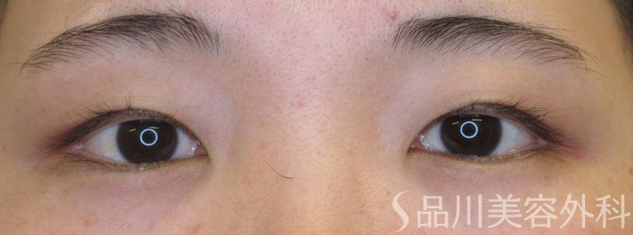症例NO.69490のBEFORE写真