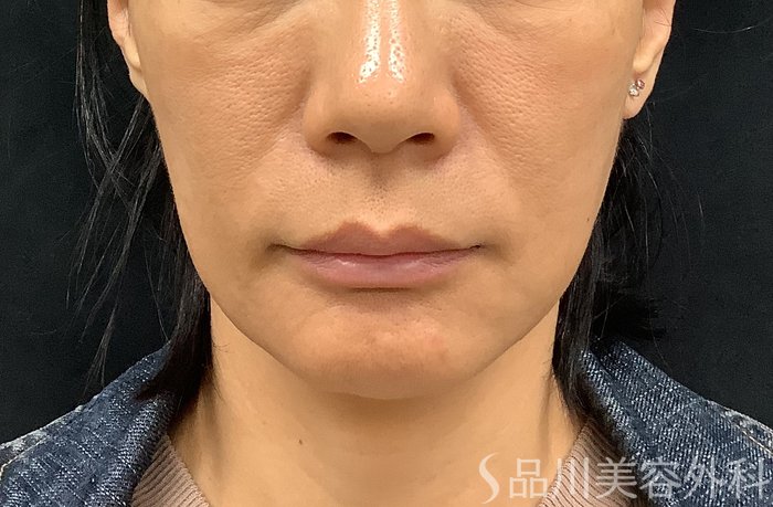 症例NO.71276のBEFORE写真