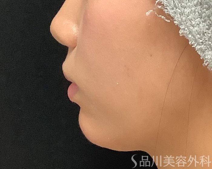 症例NO.75339のAFTER写真
