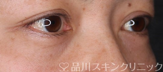 症例NO.73218のAFTER写真