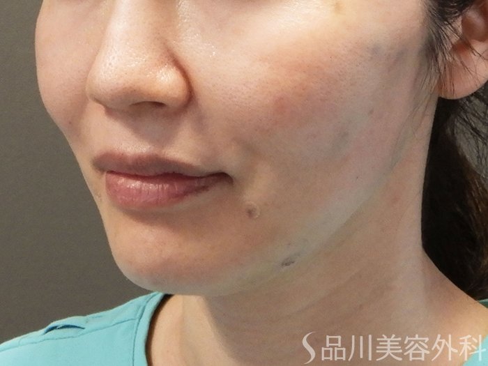 症例NO.69175のAFTER写真