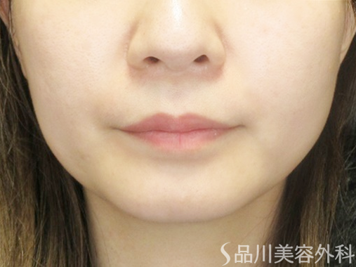 症例NO.68347のBEFORE写真
