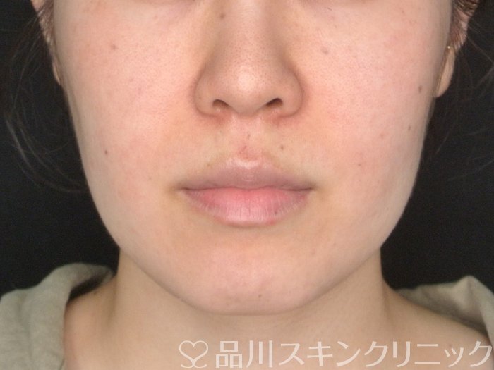症例NO.69392のBEFORE写真