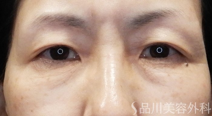 症例NO.70529のBEFORE写真