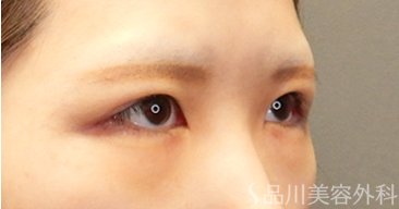 症例NO.65680のAFTER写真