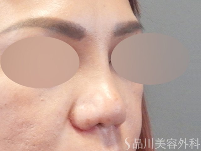 症例NO.67917のAFTER写真