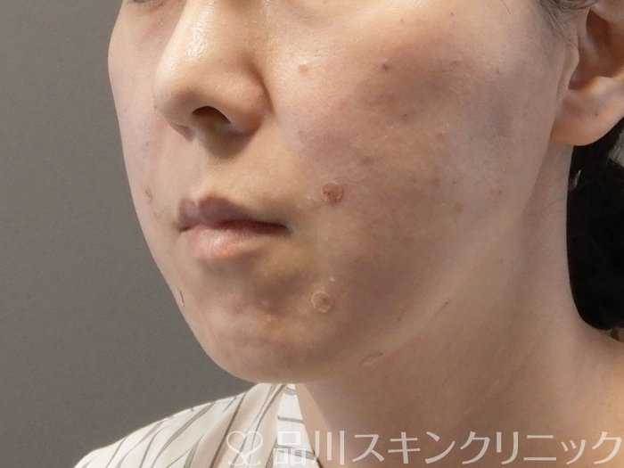 症例NO.65321のAFTER写真