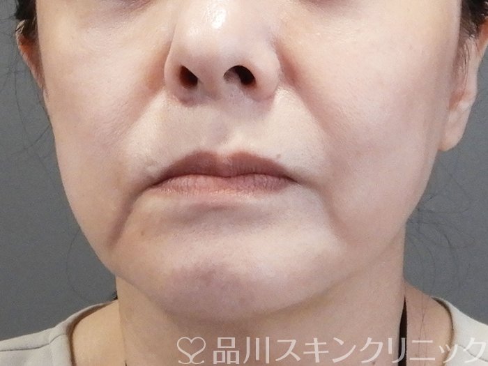 症例NO.75179のBEFORE写真