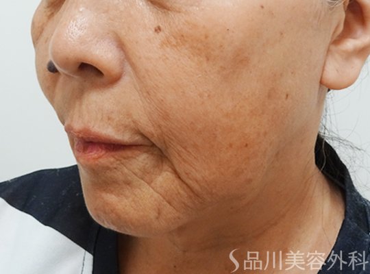 症例NO.73210のBEFORE写真