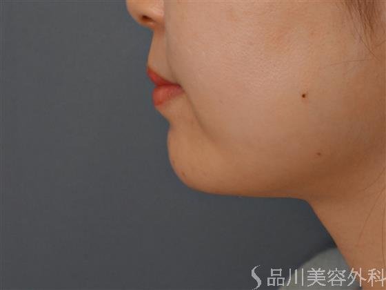 症例NO.60022のBEFORE写真