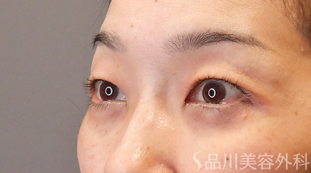 症例NO.75014のAFTER写真
