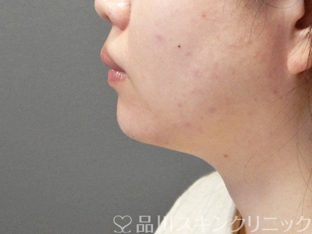 症例NO.67998のAFTER写真