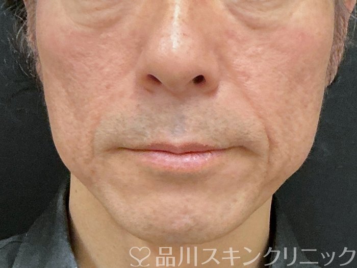 症例NO.74973のBEFORE写真