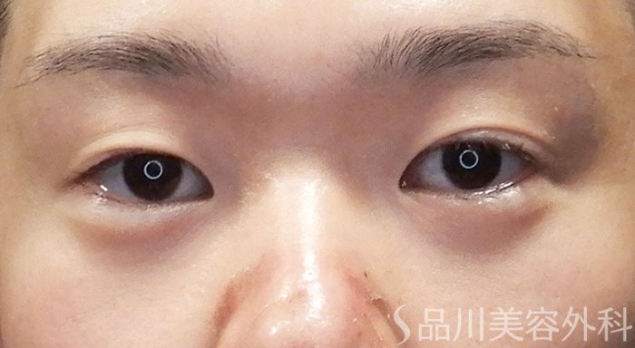 症例NO.71526のBEFORE写真