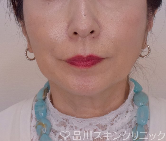 症例NO.70197のAFTER写真