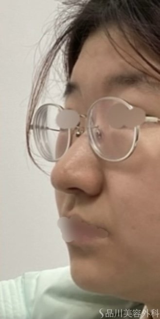 症例NO.72684のAFTER写真