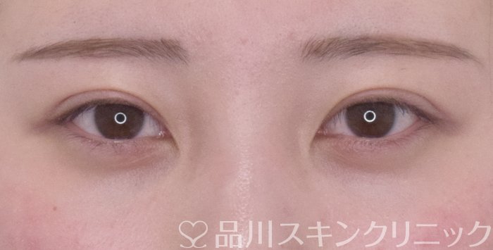 症例NO.65406のAFTER写真