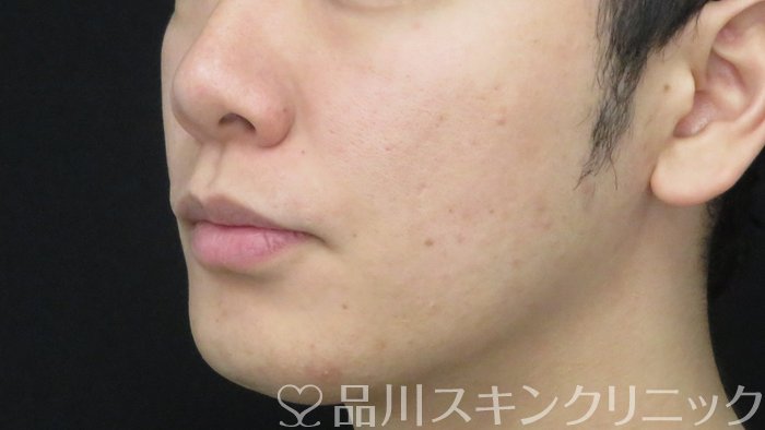 症例NO.71731のAFTER写真