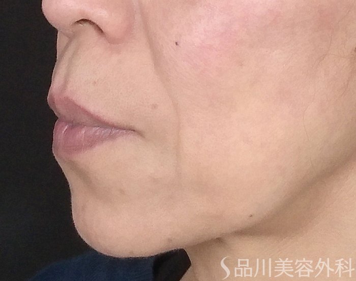 症例NO.65718のBEFORE写真