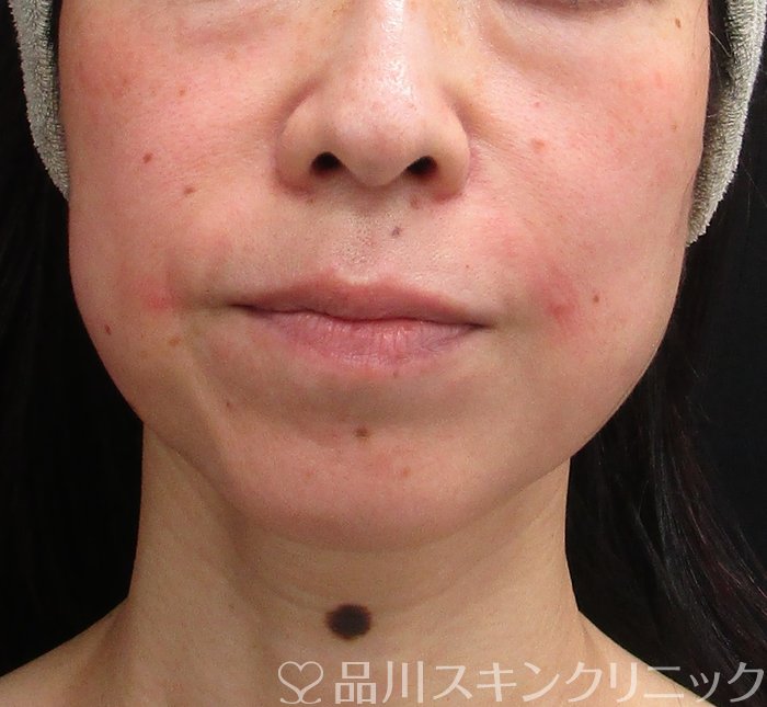 症例NO.72832のAFTER写真