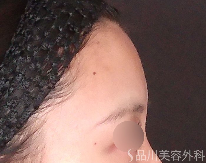症例NO.70695のBEFORE写真