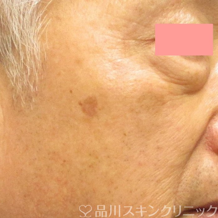 症例NO.71048のBEFORE写真