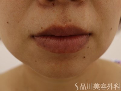 症例NO.62501のBEFORE写真