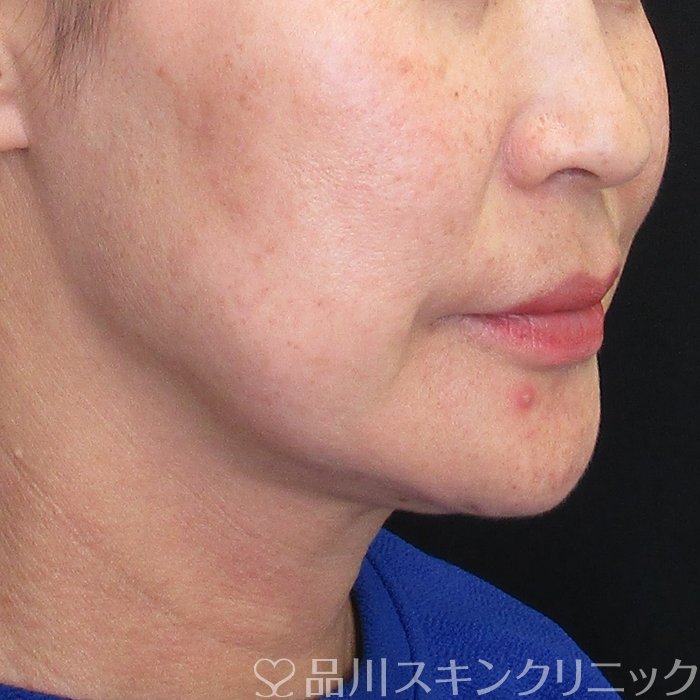 症例NO.74101のBEFORE写真