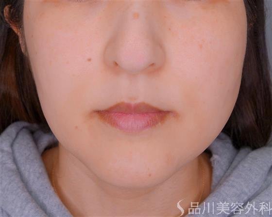 症例NO.54068のBEFORE写真