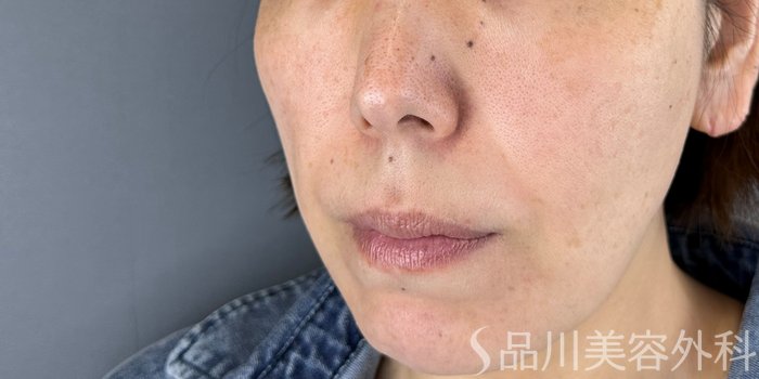 症例NO.70177のBEFORE写真