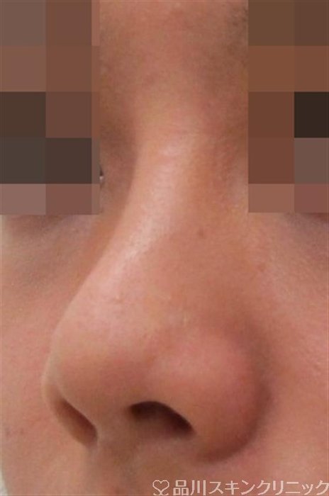 症例NO.40558のBEFORE写真