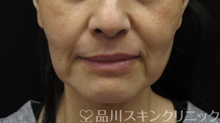 症例NO.71434のBEFORE写真