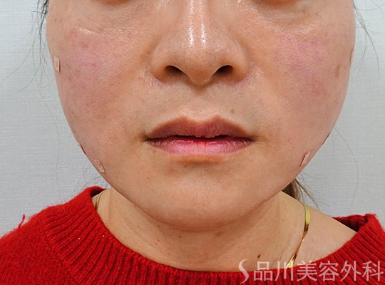 症例NO.73698のAFTER写真