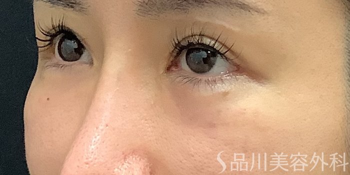 症例NO.67804のAFTER写真