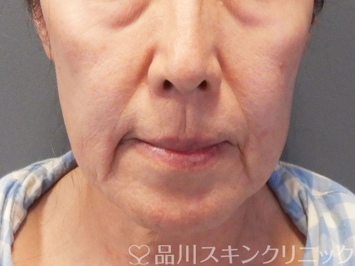 症例NO.69477のBEFORE写真