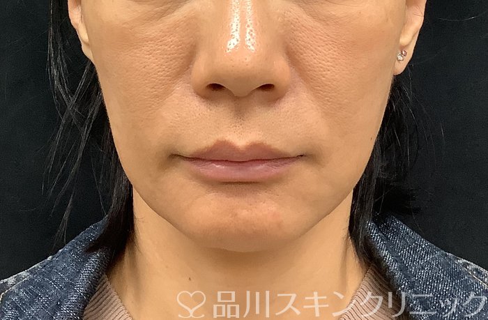 症例NO.71276のBEFORE写真
