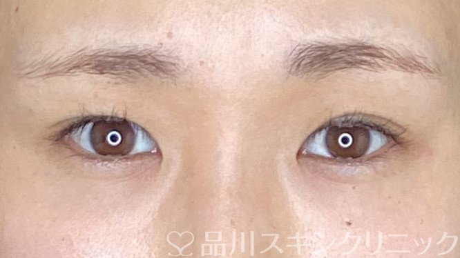 症例NO.67813のBEFORE写真
