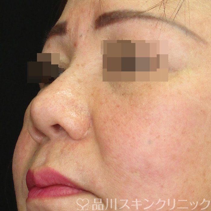 症例NO.73184のBEFORE写真