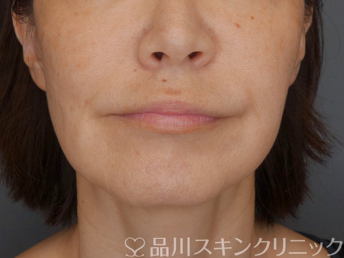 症例NO.71273のBEFORE写真