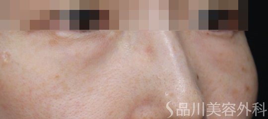 症例NO.69679のBEFORE写真
