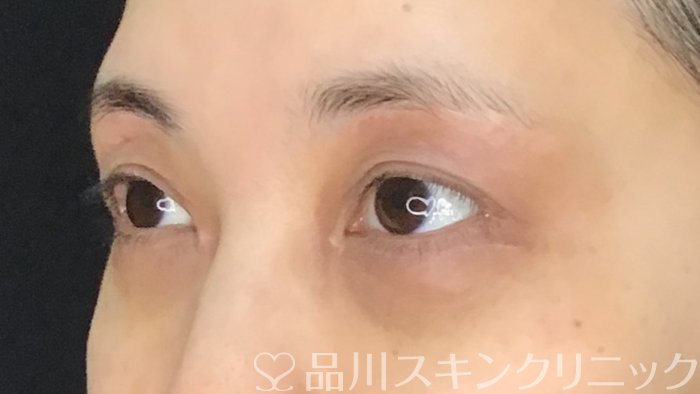 症例NO.70873のAFTER写真