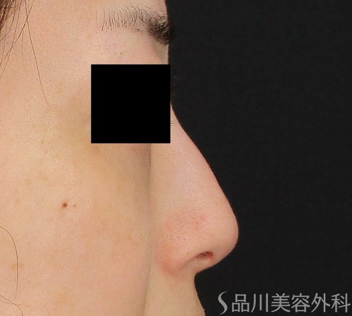 症例NO.70930のAFTER写真