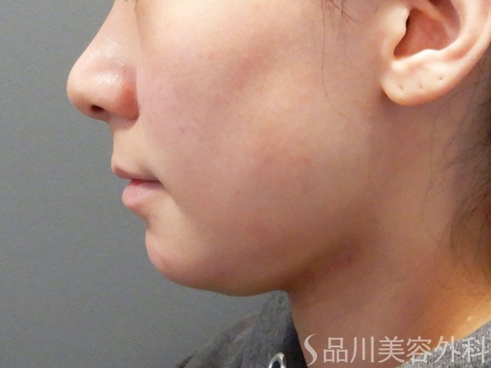 症例NO.74341のBEFORE写真