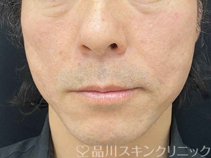 症例NO.74973のAFTER写真