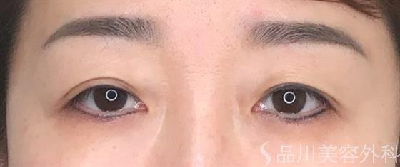 症例NO.52878のBEFORE写真