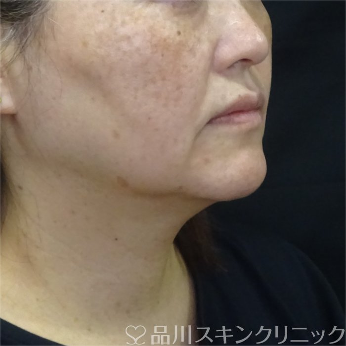 症例NO.71144のBEFORE写真