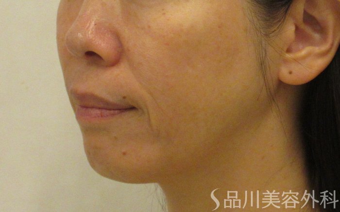 症例NO.72101のBEFORE写真