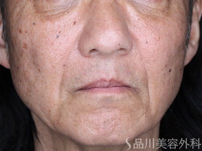 症例NO.75197のAFTER写真